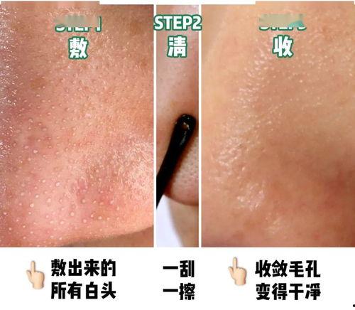 网红如何清洁黑头粉刺,告别毛孔堵塞烦恼